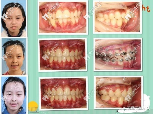 西安美奧口腔門診部兒童牙齒矯正案例