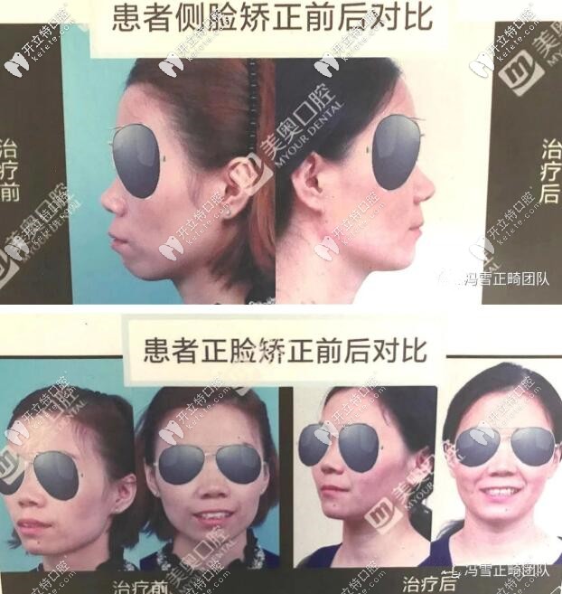 西安美奧口腔馮雪正畸團(tuán)隊(duì)案例