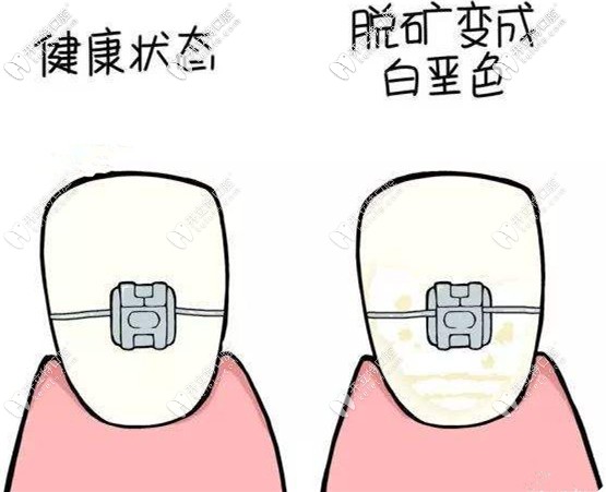 帶完金屬托槽可能會(huì)導(dǎo)致脫礦