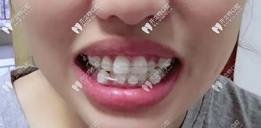 戴陶瓷自鎖托槽中期，牙齒已經(jīng)開始慢慢歸位