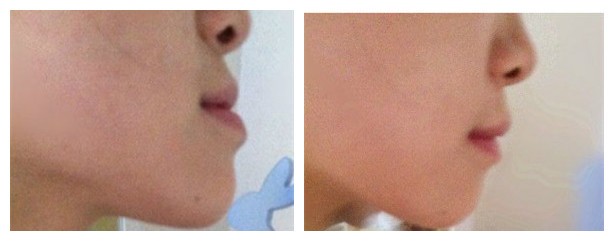 地包天帶隱適美牙套矯正效果也很贊喲!我的牙齒竟內(nèi)收了4mm