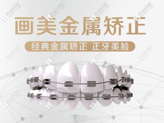 西安國(guó)產(chǎn)金屬自鎖和時(shí)代天使comfos隱形牙齒矯正價(jià)格表大全