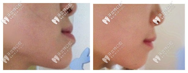 隱適美矯正地包天的效果圖