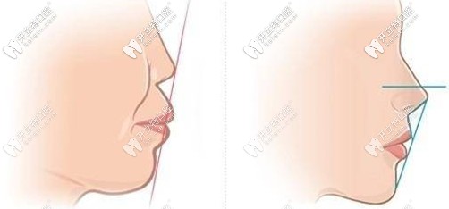 齙牙的嘴型和正常的嘴型對比圖