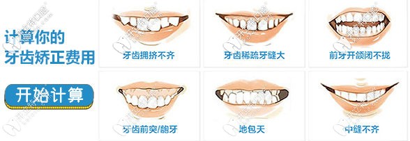 想在洛陽做隱形矯正的朋友速來關注隱適美隱形牙套價格吧