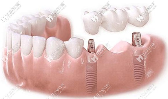 想讓種植牙為我們長(zhǎng)期服務(wù)離不開(kāi)自己的細(xì)心呵護(hù)