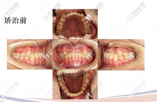 戴牙套之前的樣子