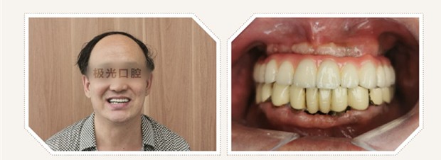 成都極光口腔上半口沒牙別戴活動假牙,在成都做4顆半口種植牙費用也不貴
