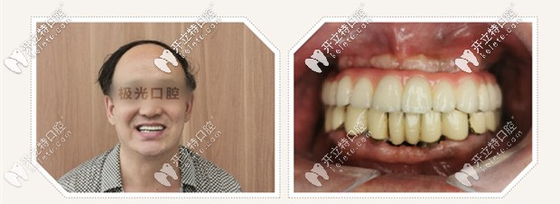 All-on-4即刻種植牙效果圖