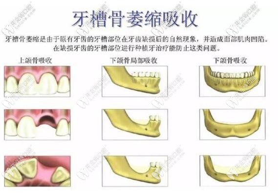牙槽骨萎縮吸收
