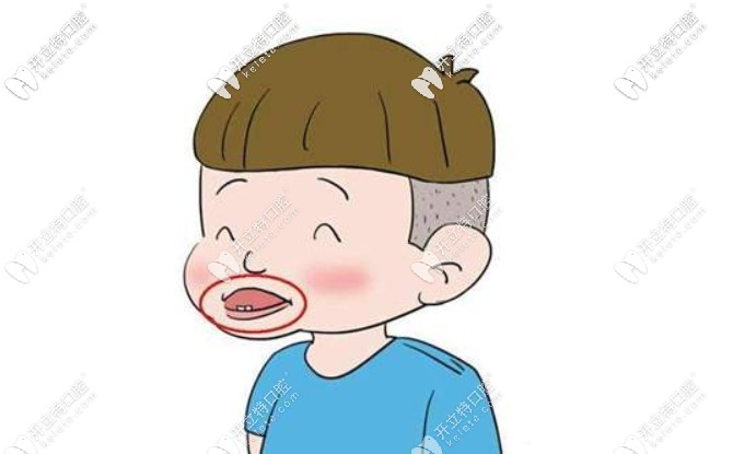  嫌羅慕矯治器與mrc麻煩，簡(jiǎn)便的嘟嘟嘴訓(xùn)練器你可不能錯(cuò)過(guò)