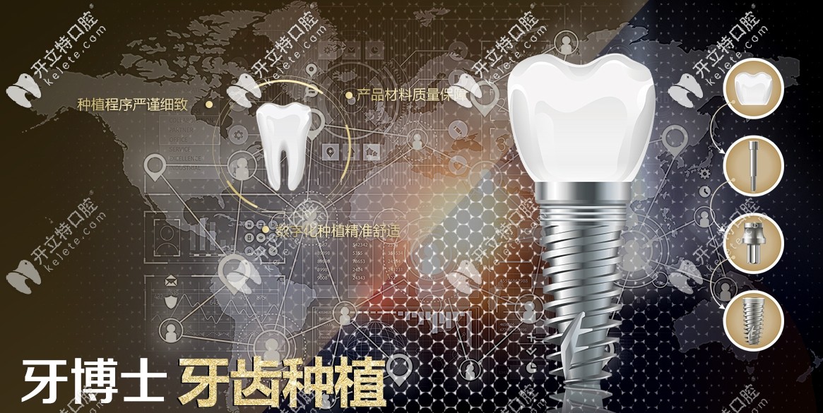 牙博士口腔牙齒種植優(yōu)勢