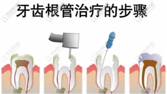 根管治療步驟圖片