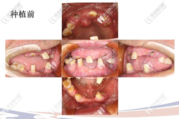 all on 4種植前牙齒情況