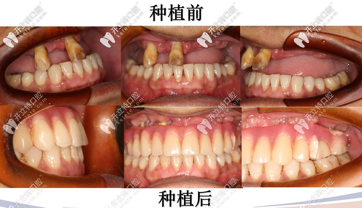 半口種植術前術后對比