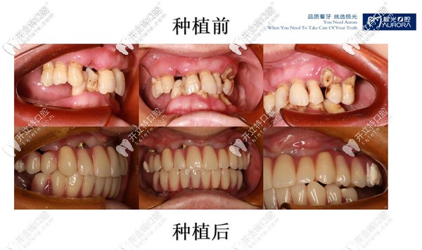 全口種植牙前后對比