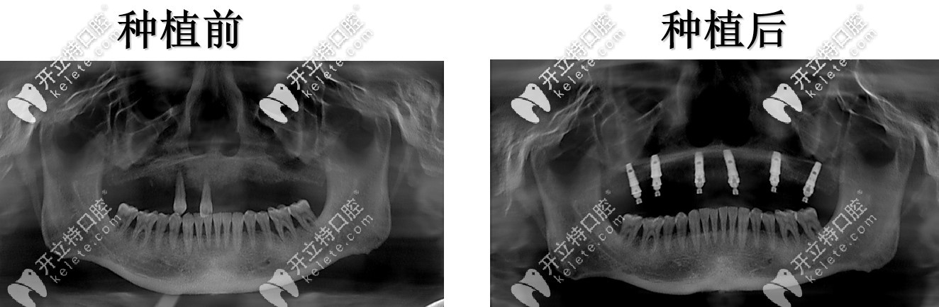 上半口六顆種植恢復