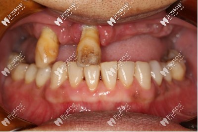 成都極光口腔45歲就做德國icx上半口種植牙,價格和恢復(fù)效果真的都不后悔