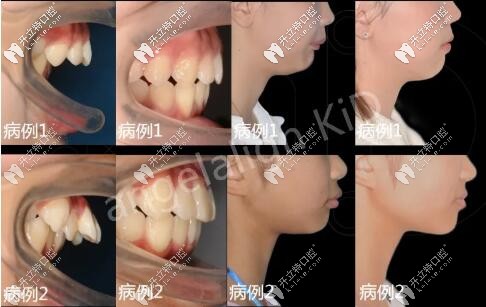 時代天使angelalign KiD兒童牙齒矯正案例