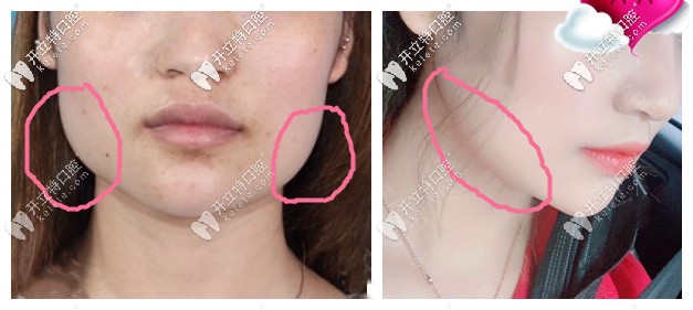 下頜骨肥大做正頜手術前后效果圖對比