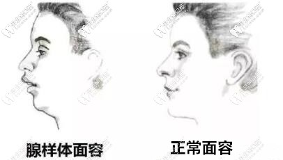 別讓這種面型毀了娃,兒童腺樣體面容戴mrc矯正器能矯正嗎？