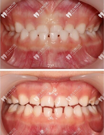 乳牙反頜蘇州寶媽竟選擇了比mrc價(jià)格貴的羅慕早期干預(yù)矯正