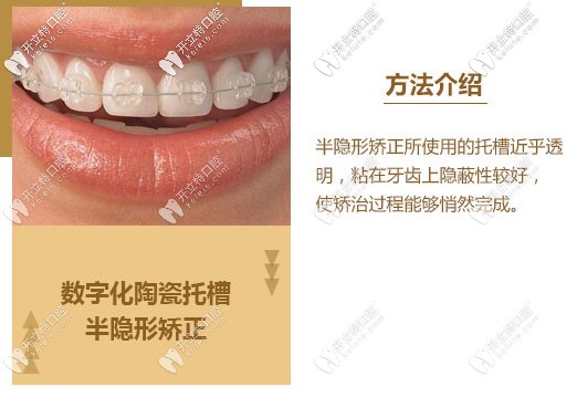 陶瓷托槽半隱形矯正圖片