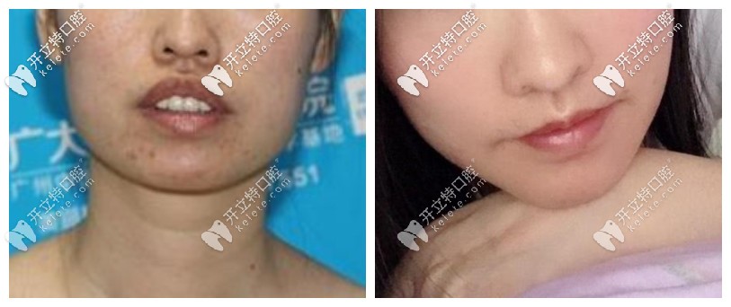 凸嘴齙牙正頜手術前后對比