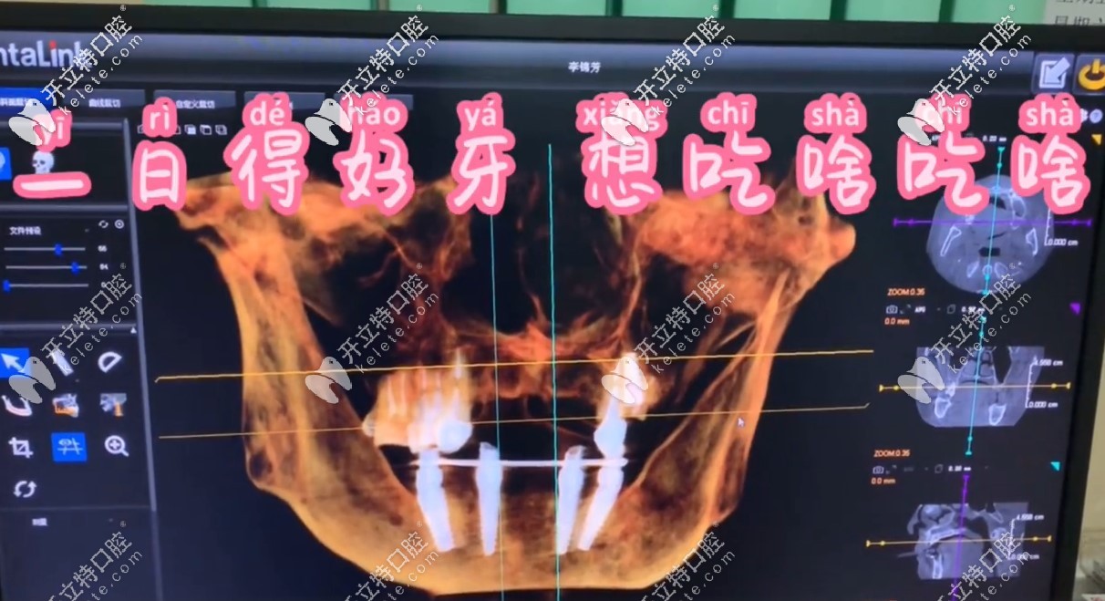 用“一日得好牙”技術(shù)種半口牙，術(shù)后即刻就能進(jìn)食