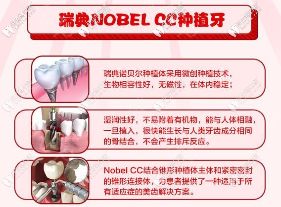 蘇州瑞典諾貝爾種植牙價(jià)格
