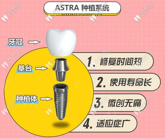 蘇州美奧口腔瑞典Astra種植體價(jià)格