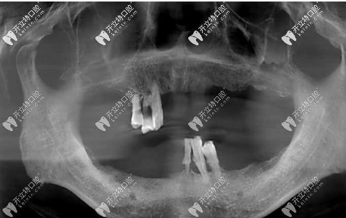 我做全口種植牙選的是astra而非諾貝爾種植體，不只因?yàn)閮r(jià)格