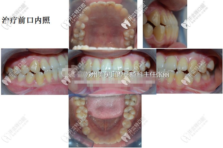 附上治療前的口內(nèi)照——上頜、左側(cè)面和右側(cè)面、下頜