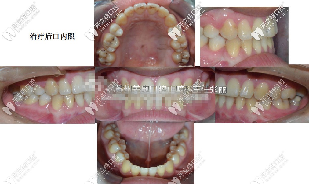 隱形矯正一年半的效果