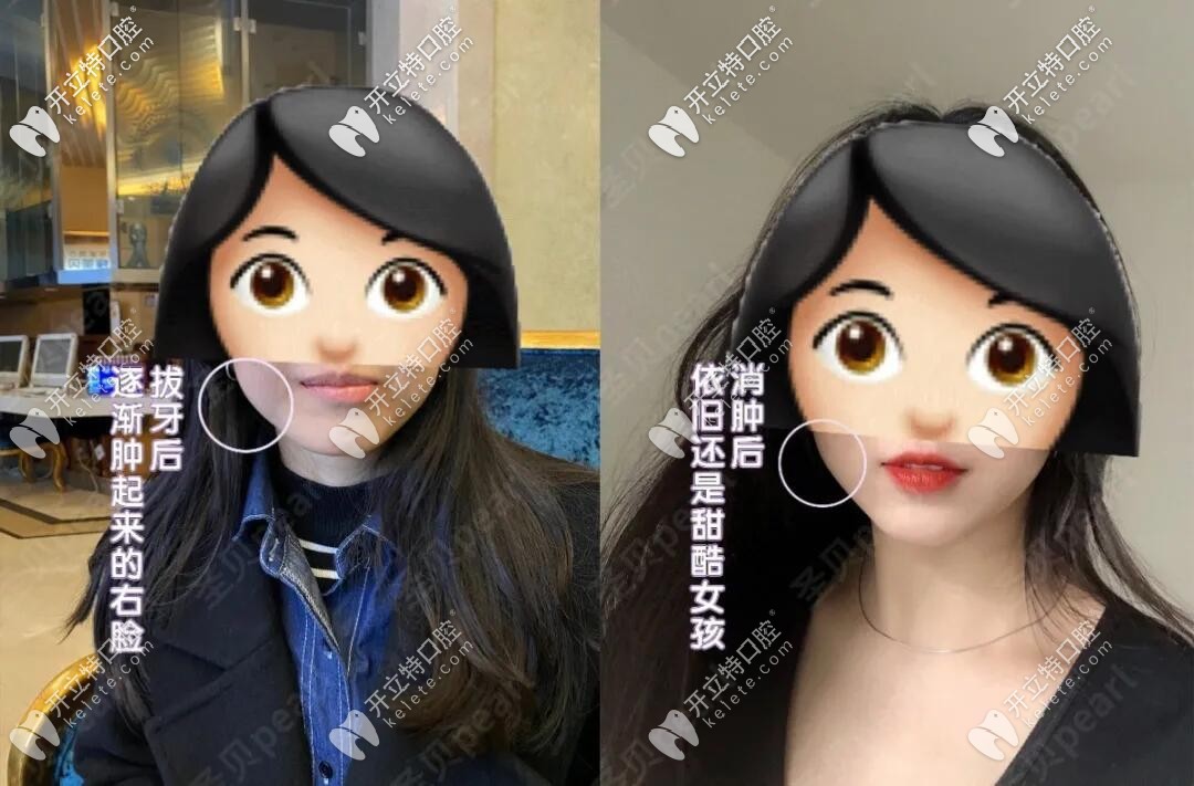 拔智齒的臉型變化圖解