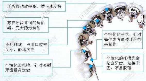 舌側(cè)矯正的優(yōu)勢