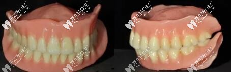 吸附性義齒圖片