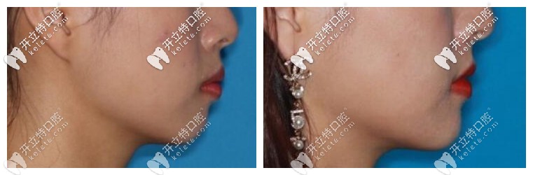 舌側(cè)隱形牙套矯正前后對比照