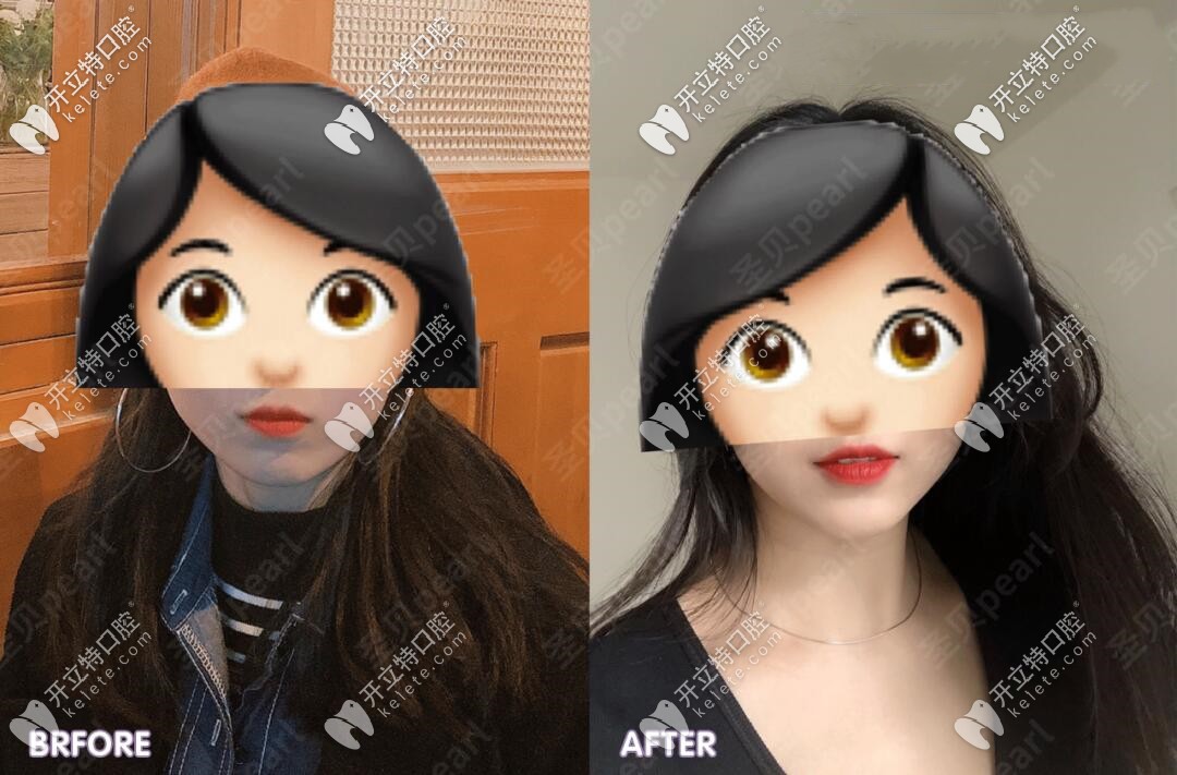 拔智齒前后臉型對比圖