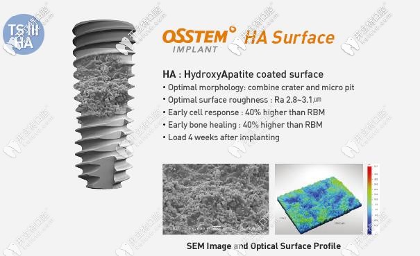 奧齒泰種植體的表面設(shè)計