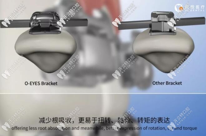 歐晴自鎖托槽矯正速度更快