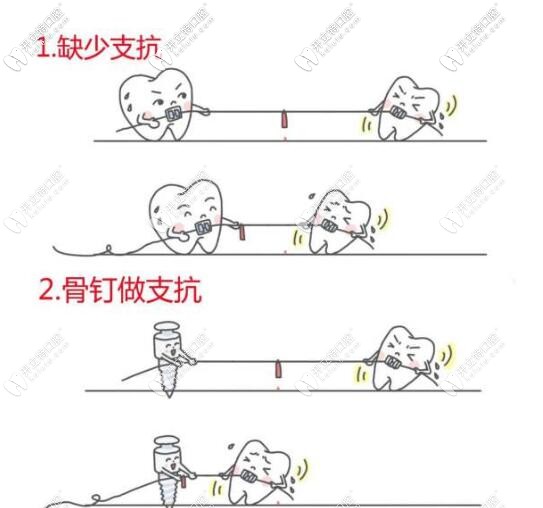 隱形矯正支抗釘