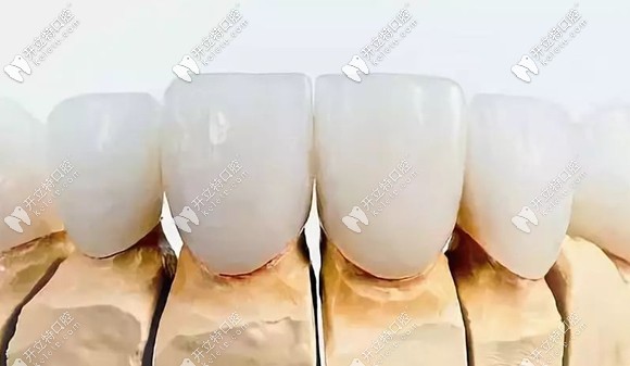 全瓷冠常見品牌及價(jià)格介紹