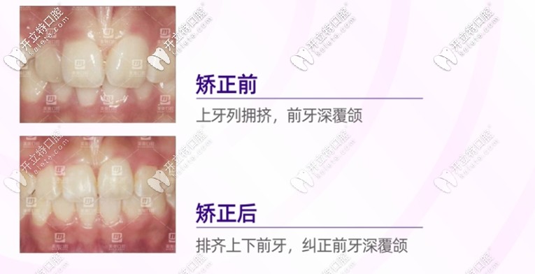 重慶美奧口腔齙牙矯正前后對比圖