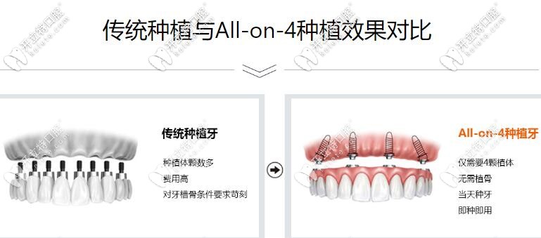 ALL-on-4即刻負(fù)重種植牙優(yōu)勢