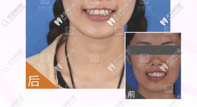 齙牙矯正牙齒前后對比圖