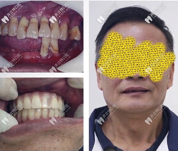 我做全口allon6即刻種植牙用了1小時(shí),過程和種牙價(jià)格我得嘮嘮