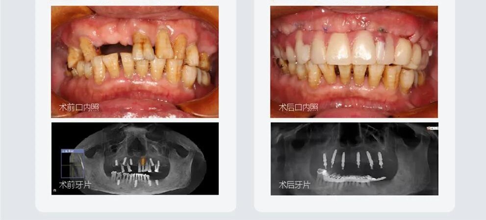 上半口無牙甭鑲牙在成都做all on 6微創(chuàng)種植牙當天就能吃東西