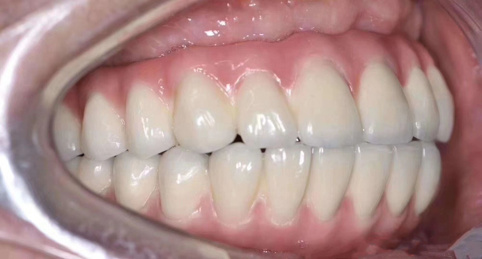 牙周病滿口沒牙不想活了?沈陽的全口即刻種植牙3h恢復(fù)咀嚼