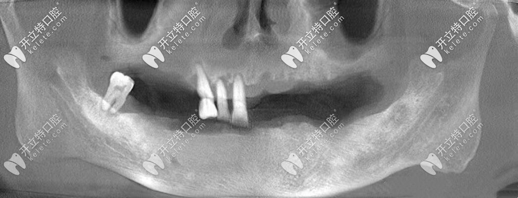 做種植牙之前照片